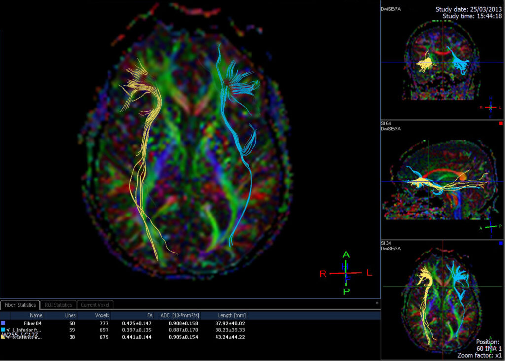 Diffusion tensor imaging (DTI) scan showing white‑matter pathways affected by concussion